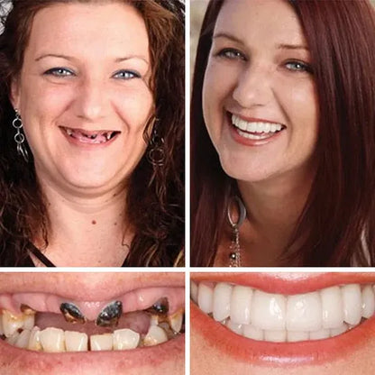 🌎Ends Today: 70% OFF! ⏰meleval® Medical Full Denture with Strong Suctiond🦷Obtain American Dental Association (ADA) Certification