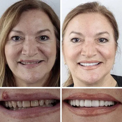 🌎Ends Today: 70% OFF! ⏰meleval® Medical Full Denture with Strong Suctiond🦷Obtain American Dental Association (ADA) Certification
